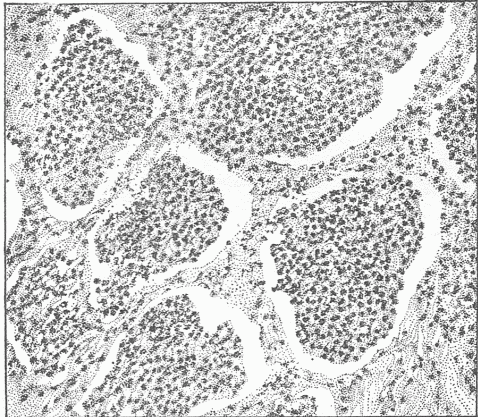 Fig. 15&mdash;A Section Of An Inflamed Lung Showing The Exudate Within The Air Spaces. Compare this with Fig 6. Fig 15 is from the human lung, in which the air spaces are much larger than in the mouse.