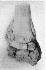 Fig. 15&mdash;Distal end of radius. Illustrating the effects of chronic carpitis.