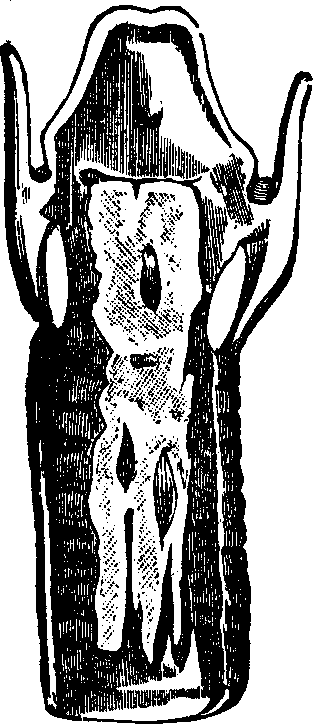 Illustration:
Fig. 1. False Membrane in Croup. From a specimen in Dr. Gross' cabinet.