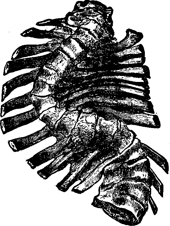 Illustration:
Fig. 8. Lateral curvature in an advanced stage. 