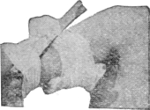 The bandage twisted tightly by means of a windlass (stick) which is
held by another bandage