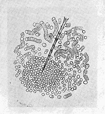37. (b) Effect of the poison on the blood corpuscles
of man. After Tyzzer.